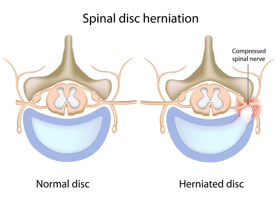 Spinal disc herniation Illustration